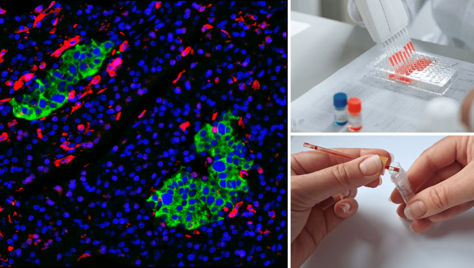 Left : Immune cells (stained red) attacking the insulin producing islet cells (stained green) in the pancreas.Top right : Laboratory scientist using a multi-channel pipette. Bottom right : Removing the feeder straw to the capillary blood collection tube.